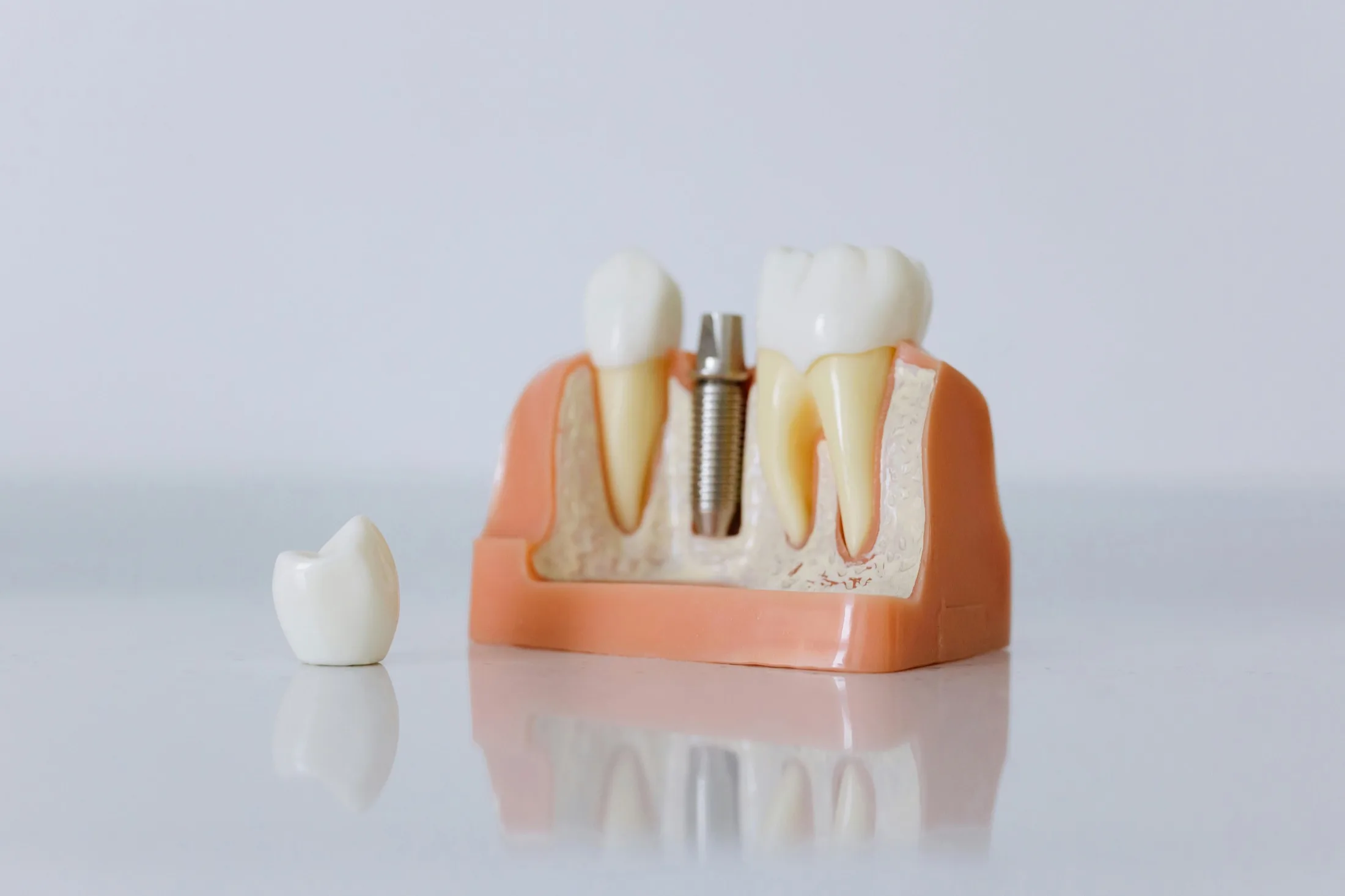 Modelo anatômico de implante dental