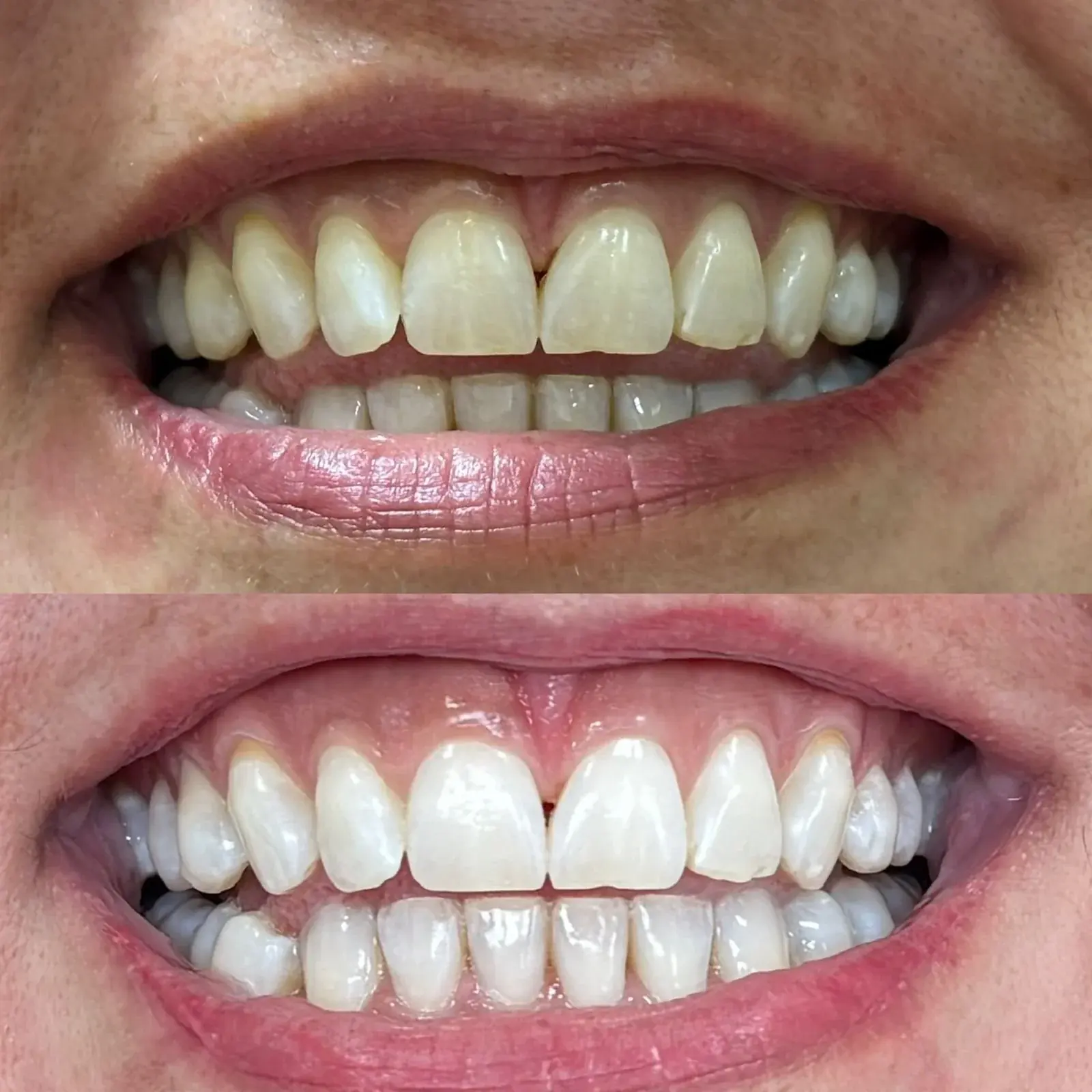 Como clarear os dentes de forma segura: guia completo
